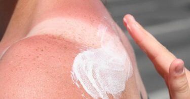 Hier kommt die Sonnencreme zu spät, die Haut ist schon verbrannt. Was hilft nun noch?. Foto: Stephanie Pilick/dpa/dpa-tmn