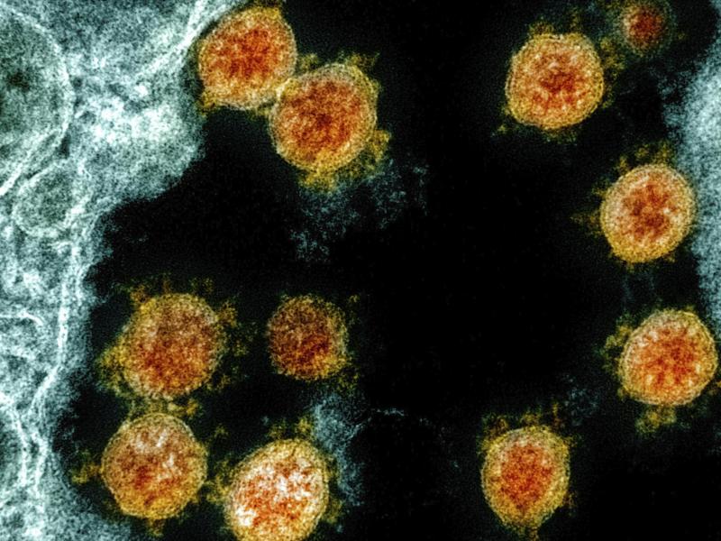 Diese elektronenmikroskopische Aufnahme aus dem Jahr 2020 wurde farblich bearbeitet und zeigt Partikel des Coronavirus SARS-CoV-2. Foto: Uncredited/NIAID/NIH/dpa
