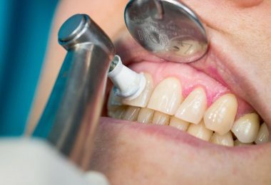 Regelmäßige professionelle Zahnreinigungen beugen Zahnfleischproblemen vor. Foto: Frank Rumpenhorst/dpa-tmn
