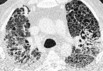 Computertomographie-Aufnahme (CT-Bild) der Lunge eines Patienten mit COVID-19-Lungenversagen. Helle Bereiche zeigen Verdichtungen und Vernarbungen des Lungengewebes. Foto: -/Charité/dpa