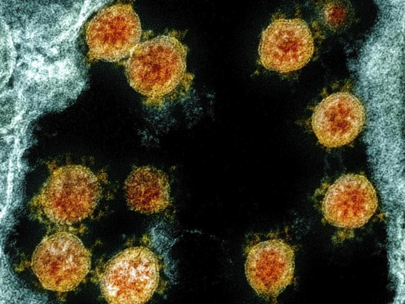 Eine elektronenmikroskopische Aufnahme zeigt Partikel des Coronavirus SARS-CoV-2. (Archivbild). Foto: Uncredited/NIAID/NIH/dpa