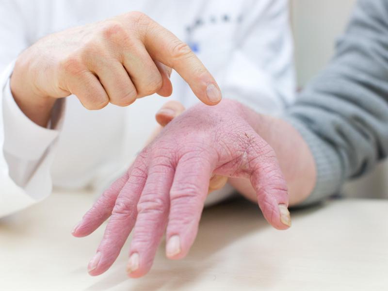 Hautekzeme können prinzipiell überall am Körper vorkommen. Besonders oft sind Hände und Gesicht betroffen. Foto: Friso Gentsch/dpa/dpa-tmn