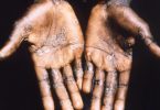 Die Handflächen eines Affenpockenpatienten zeigen einen Ausschlag. Foto: -/CDC/Brian W.J. Mahy/dpa/Archiv