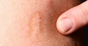 Die Pocken zählten lange zu den gefährlichsten Krankheiten überhaupt für den Menschen. Foto: Bernd Weißbrod/dpa