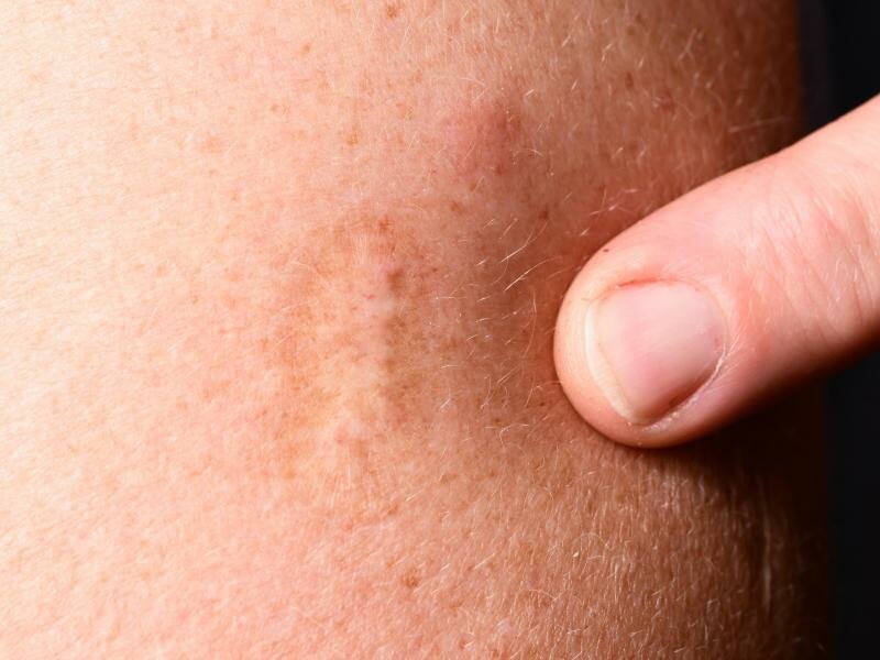 Die Pocken zählten lange zu den gefährlichsten Krankheiten überhaupt für den Menschen. Foto: Bernd Weißbrod/dpa/Archivbild