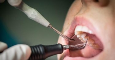 Wer regelmäßig zur Vorsorge geht und seine Zähne professionell reinigen lässt, kann Parodontitis vorbeugen. Besonders wichtig ist das für Diabetiker. Foto: Frank Rumpenhorst/dpa-tmn